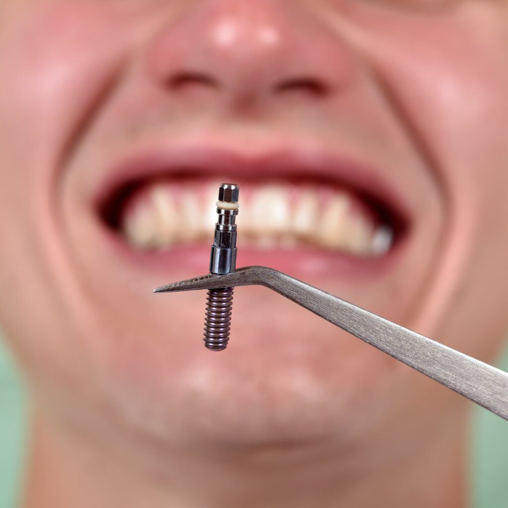 غرسة معدنية للفك لزرع الاسنان