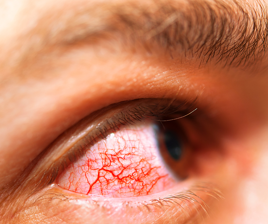 شعيرات دموية ظاهرة على عين إنسان
