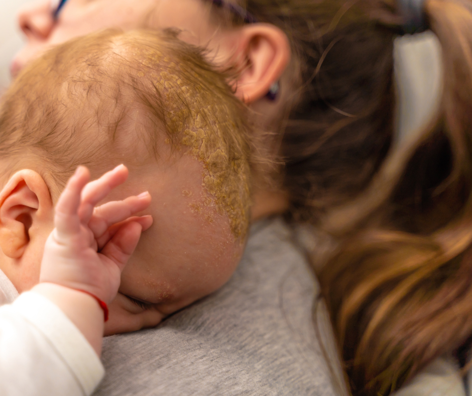 علاج الأكزيما الدهنية عند الأطفال الرضع
