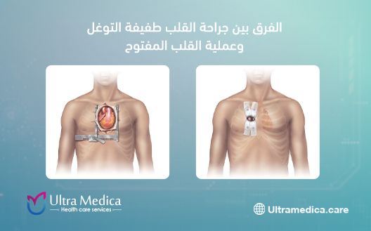 الفرق بين جراحة القلب طفيفة التوغل وعملية القلب المفتوح