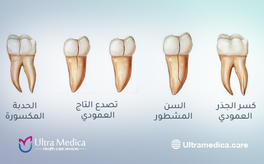 انواع كسور الأسنان