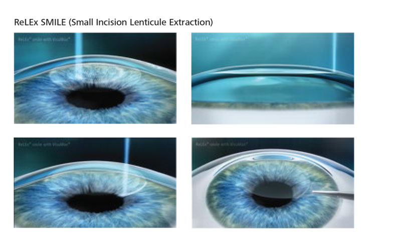 استخراج العدسة بشق صغير الفمتو سمايل (SMILE - Small incision lenticule extraction)