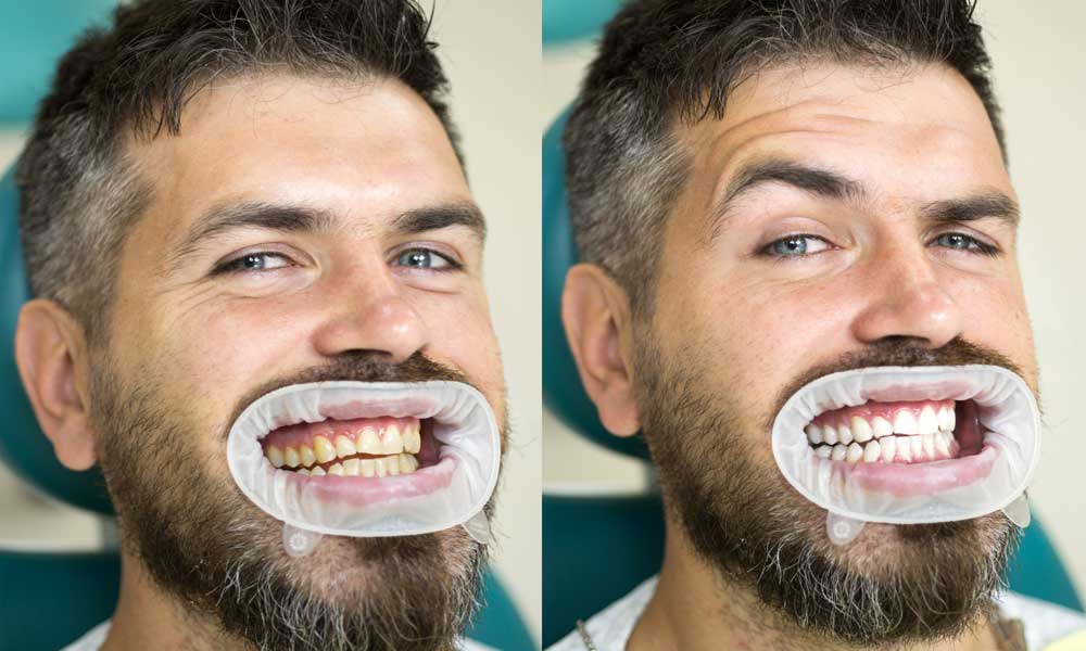 أسنان رجل قبل و بعد تبيض الأسنان