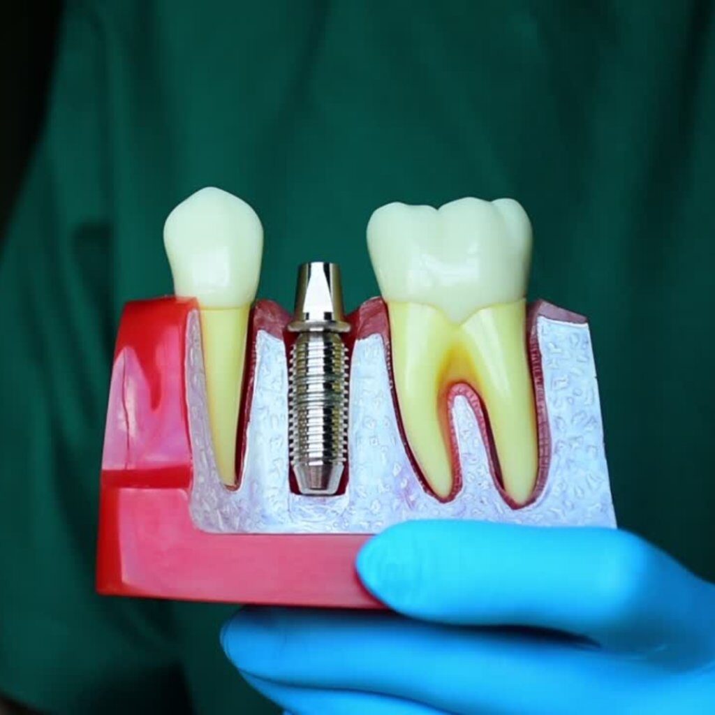 مجسم يوضح شكل غرسة الأسنان الاصطناعية